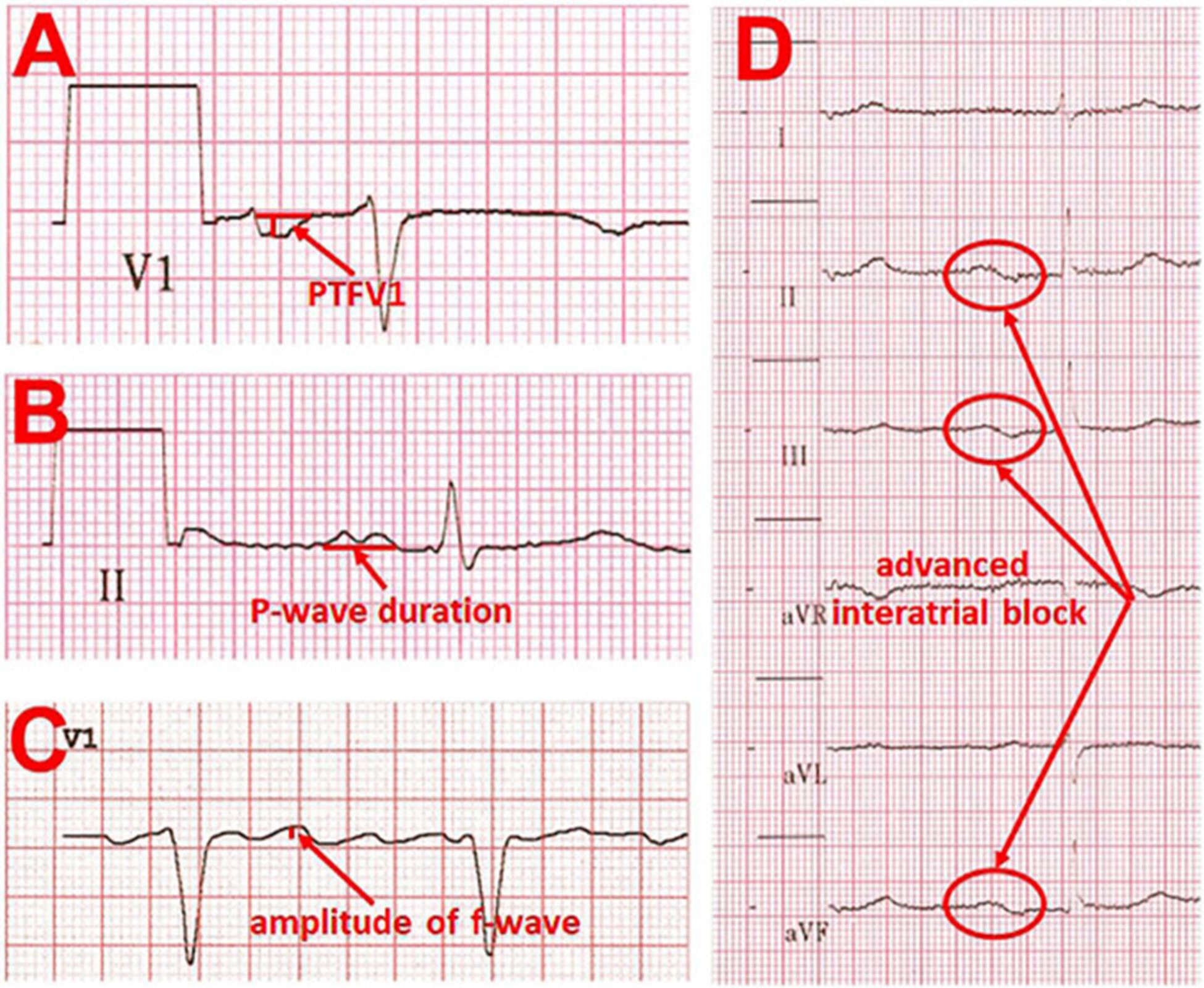 【佳学基因检测】左心房心肌病的基因解码、基因检测及其个性化的治疗
